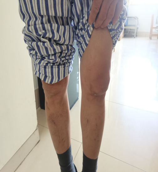 膝盖针扎样的疼，不敢走路，怎么回事？