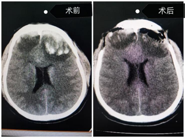 两院极速响应，协同一体救治！重型颅脑损伤患者成功脱险