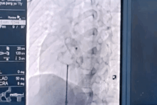 微创精准·心愈无痕——25 mm 房间隔缺损封堵彰显技术硬实力