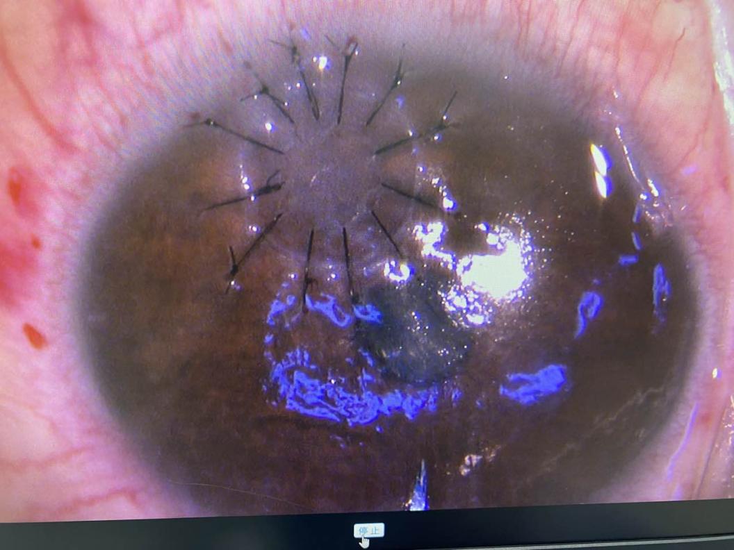 「在鸡蛋内膜上剥蛋壳」！  南方科技大学医院成功开展深板层角膜移植术