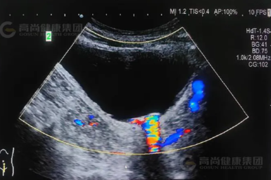 【超声病例】「翻滚」的小石头—膀胱结石