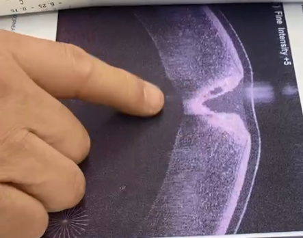 「在鸡蛋内膜上剥蛋壳」！  南方科技大学医院成功开展深板层角膜移植术