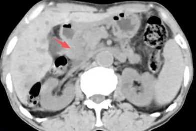 【高尚病例】长期腹痛，需警惕十二指肠癌