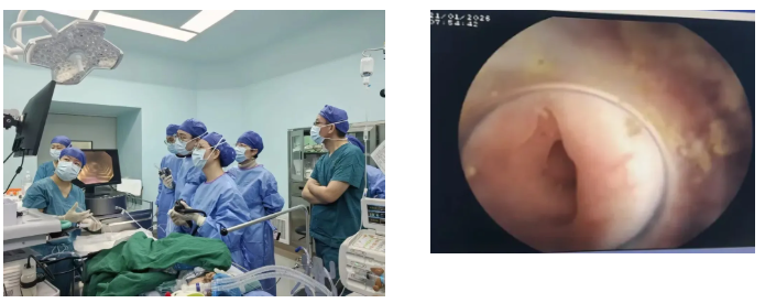 深圳市妇幼保健院成功开展儿童内镜逆行阑尾炎治疗术（ERAT）