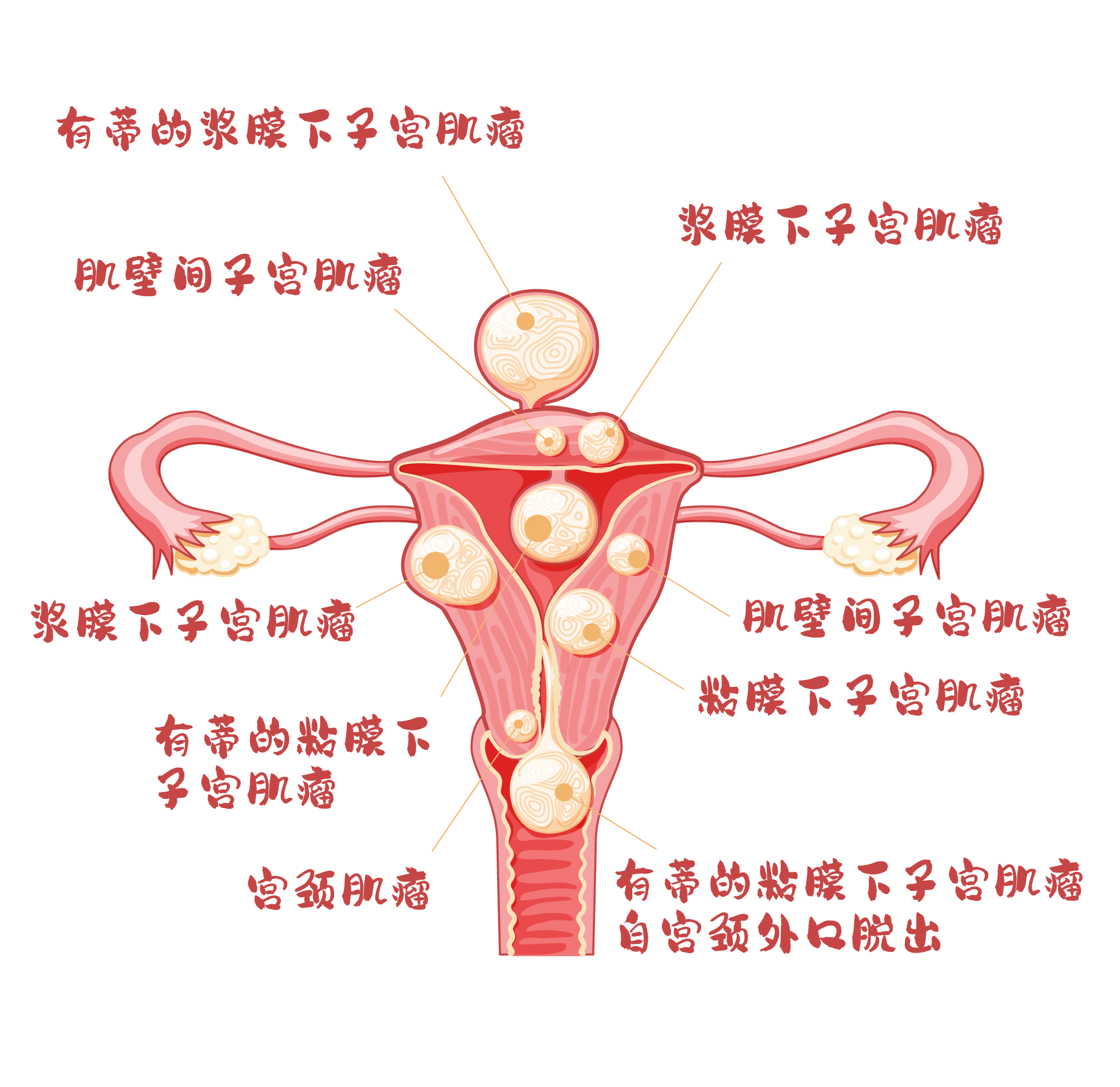 当孕期遭遇子宫肌瘤，明德来护航