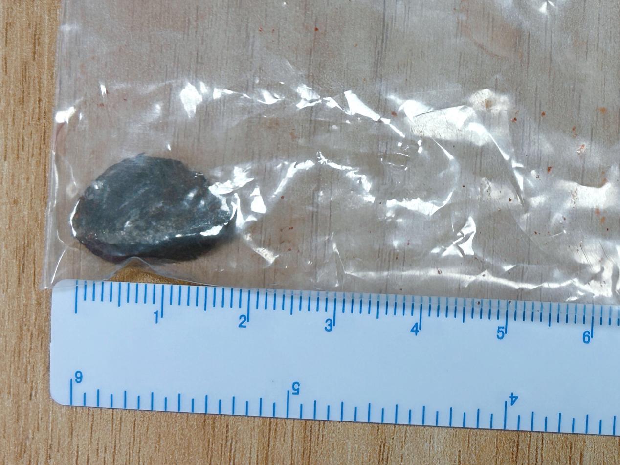 惊险！男子被飞溅 2 厘米金属异物贯穿左眼眶！专家团队另辟蹊径保视力