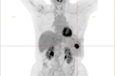 【高尚病例】PET/CT 发现肋骨孤立性浆细胞瘤 1 例