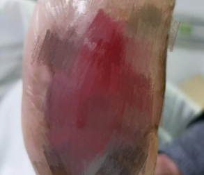 重度糖尿病足患者险截肢,黄飞团队保足成功