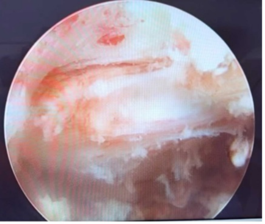 罕见病让她「瘫痪」不起，他们「精准」清除病灶助力恢复行走