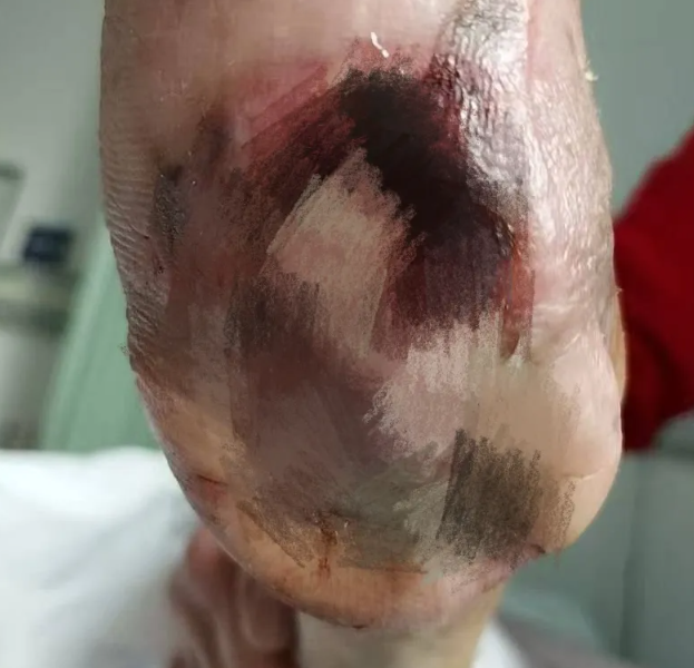 重度糖尿病足患者险截肢,黄飞团队保足成功