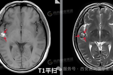 【高尚病例】头颅 T2-FLAIR 序列增强扫描的意义及临床应用