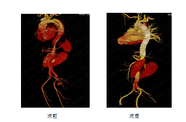 西交一血管外科成功完成复杂胸主动脉夹层合并马蹄肾介入手术