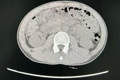 床旁超声引导留置空肠管技术，为重症胰腺炎患者打开「生命营养通道」