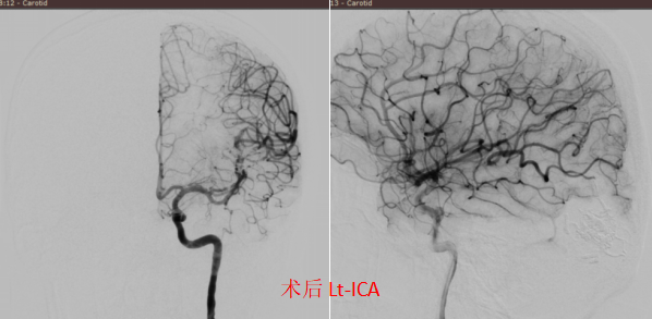 一场突发的头痛:32 岁外籍青年的「脑内危机」