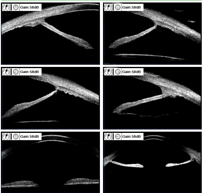 男子左眼视物重影 竟是 9 年前植入的人工晶体「失踪」了