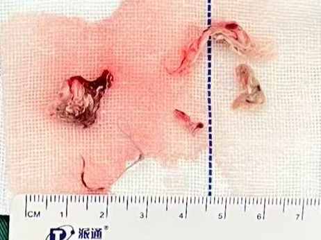 寒假这种意外频发!儿童医院:两年 1331 个娃中招