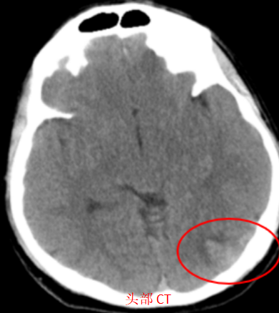 一场突发的头痛:32 岁外籍青年的「脑内危机」