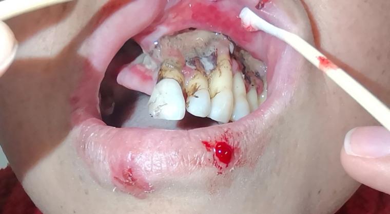 女子牙龈流脓两年不治，半口牙「全军覆没」