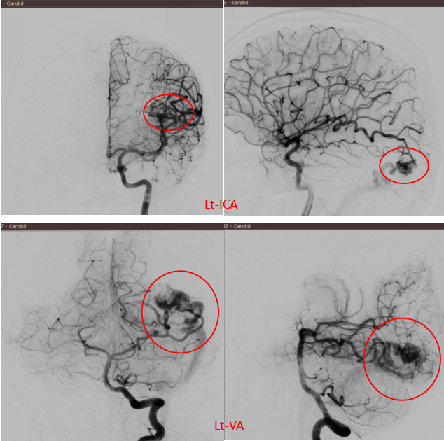 一场突发的头痛:32 岁外籍青年的「脑内危机」