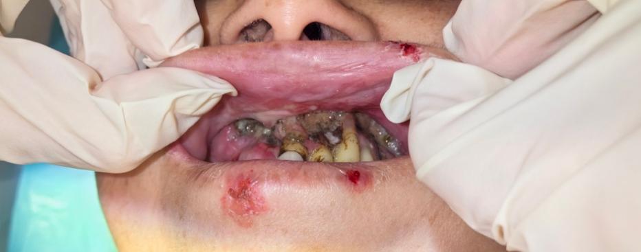 女子牙龈流脓两年不治，半口牙「全军覆没」