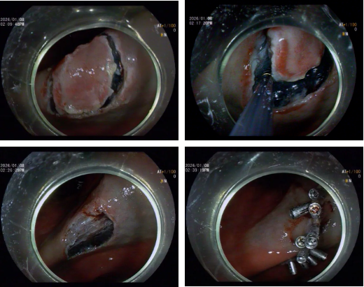 内镜黏膜下剥离术 ESD| 「愈」鉴「胃」来,镜下「拆弹」