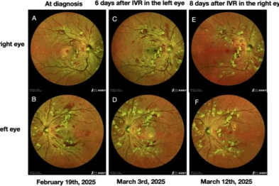 吴彤/李智慧主任及陶勇教授合作团队：首次报道 CAR-T 桥接移植后 Purtscher 样视网膜病变病例