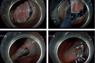 内镜黏膜下剥离术 ESD｜ 「愈」鉴「胃」来，镜下「拆弹」