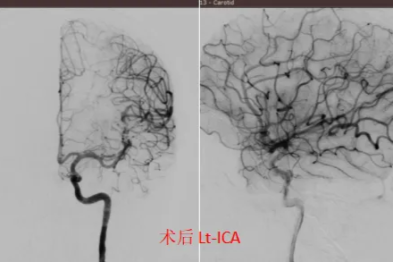 一场突发的头痛：32 岁外籍青年的「脑内危机」