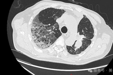 复杂心肺术后并发重症肺炎合并呼吸衰竭——多学科协作助力高龄患者闯过「心肺难关」