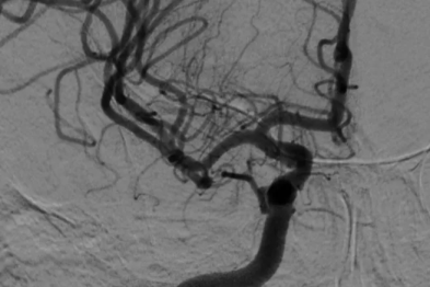 90 岁老人突发脑卒中  取栓手术破「高龄桎梏」