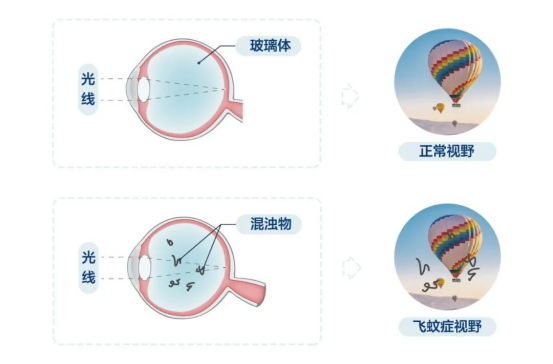 春节长假，眼前飘「黑影」？别让飞蚊症和糖尿病眼病搅了团聚好心情