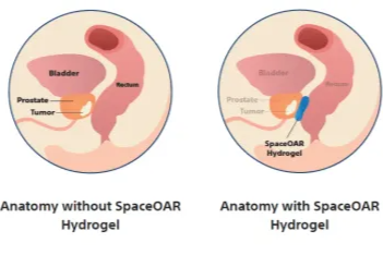 新技术破解前列腺癌患者的放疗难题——疗效与副作用