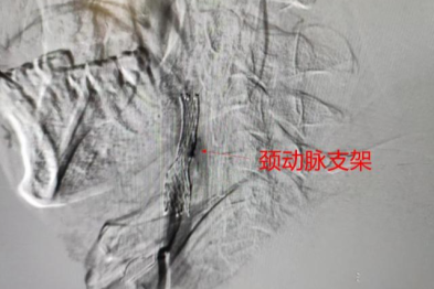 颈动脉有斑块，万一堵上是不是就梗过去了？合肥京东方医院「伞下支架」边疏通边捕获