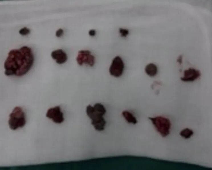 以为「小突起」无关紧要，20 岁男生确诊尖锐湿疣