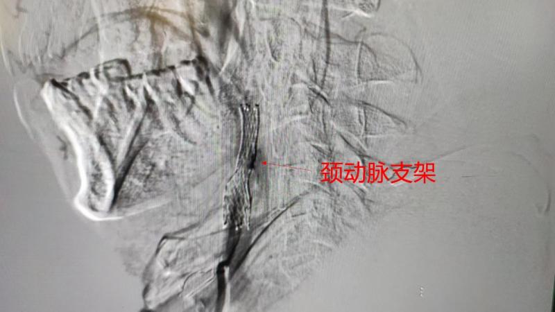 颈动脉有斑块，万一堵上是不是就梗过去了？合肥京东方医院「伞下支架」边疏通边捕获