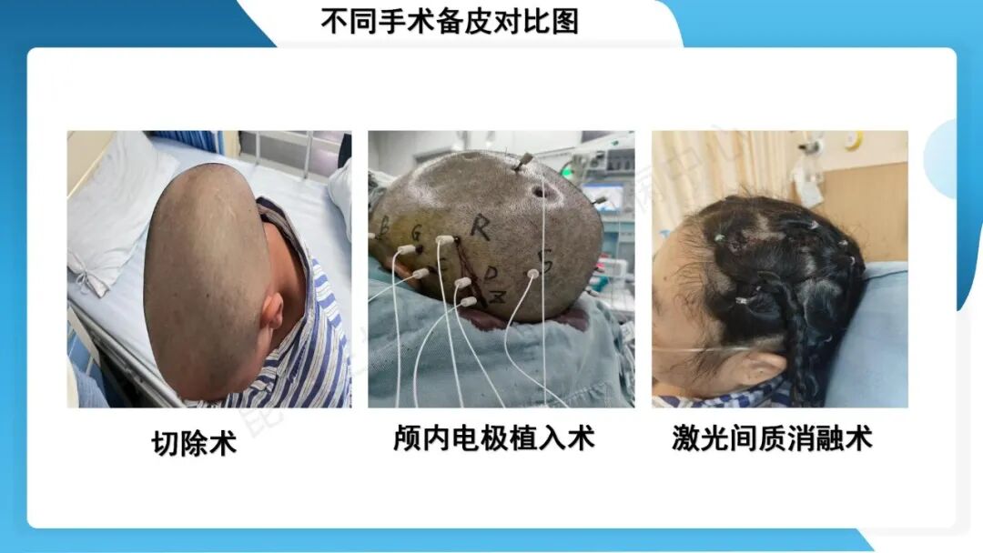 癫痫患者术前准备