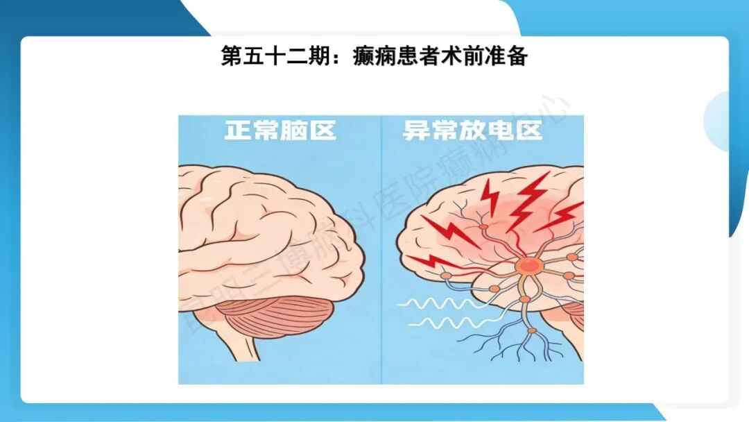 癫痫患者术前准备
