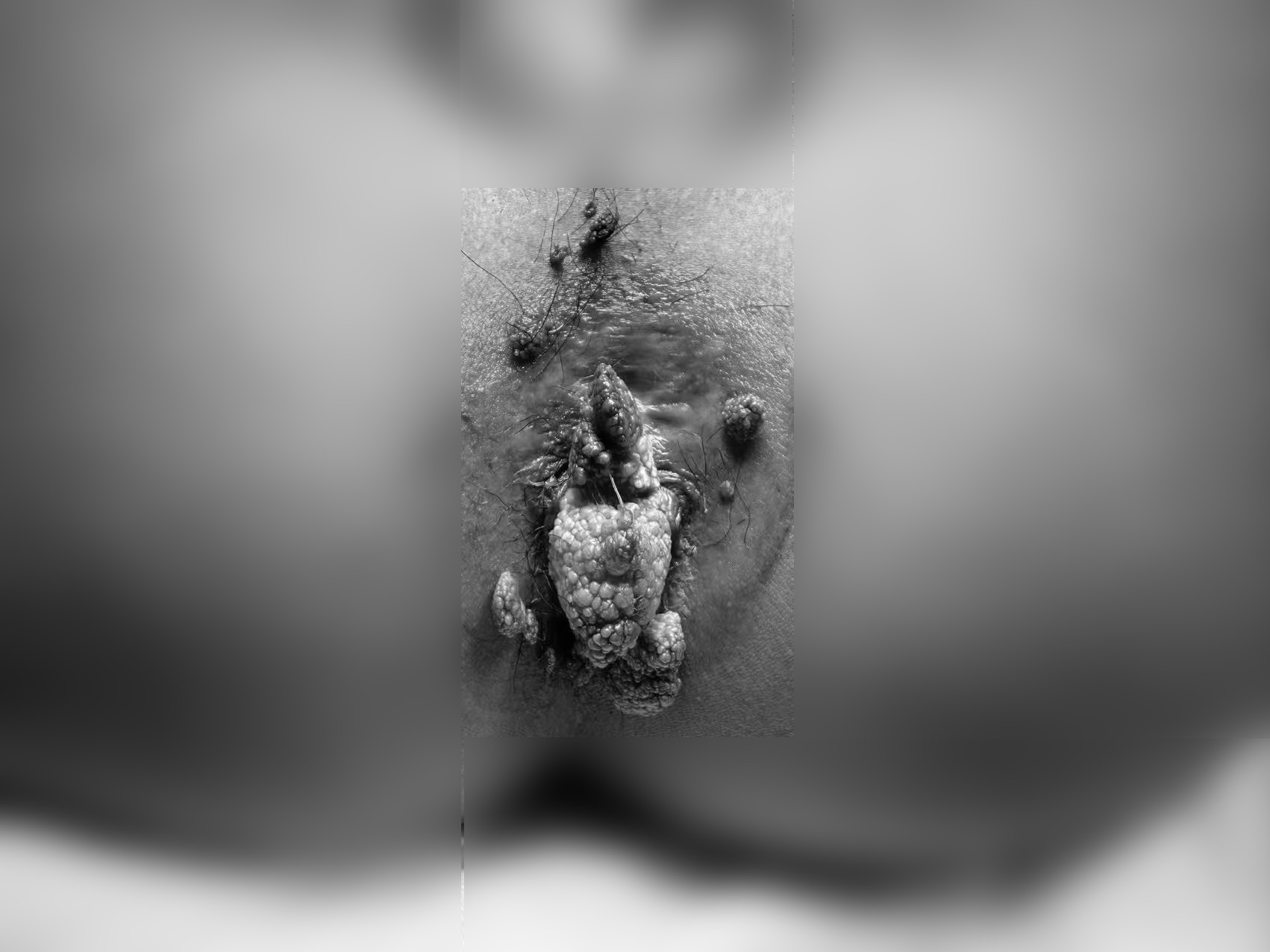 以为「小突起」无关紧要，20 岁男生确诊尖锐湿疣