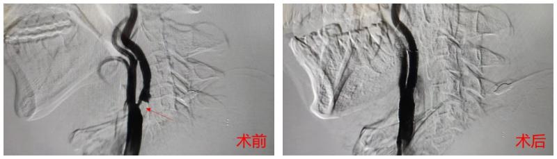颈动脉有斑块，万一堵上是不是就梗过去了？合肥京东方医院「伞下支架」边疏通边捕获