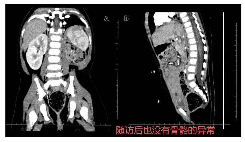 4 个月婴儿双原发恶性肿瘤质子治疗——河北一洲肿瘤医院研究发表于《Frontiers in Oncology》