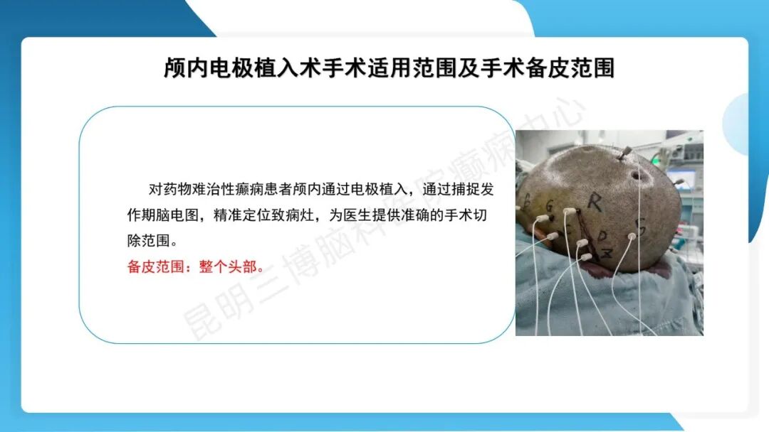 癫痫患者术前准备