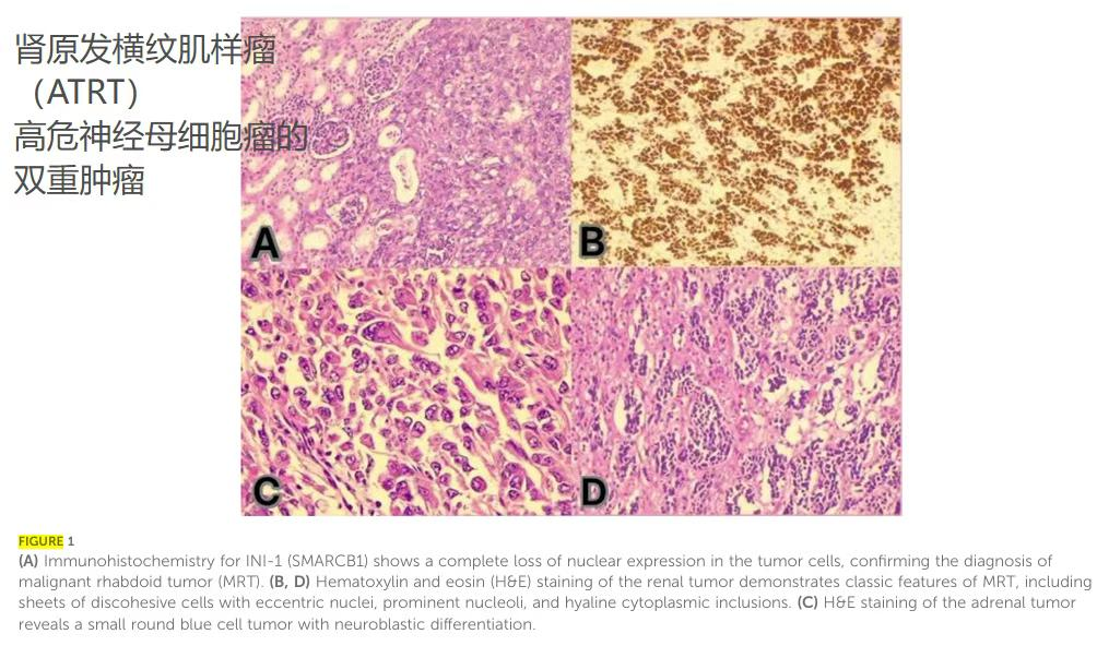 4 个月婴儿双原发恶性肿瘤质子治疗——河北一洲肿瘤医院研究发表于《Frontiers in Oncology》