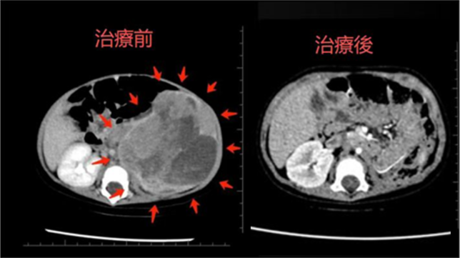 4 个月婴儿双原发恶性肿瘤质子治疗——河北一洲肿瘤医院研究发表于《Frontiers in Oncology》