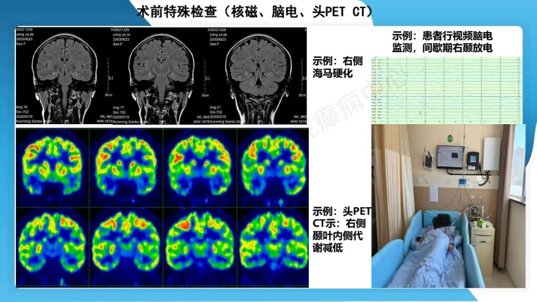 癫痫患者术前准备