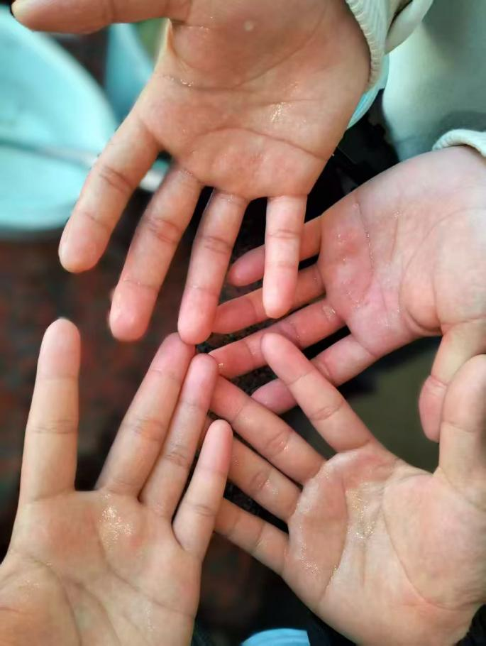 漳州第三医院陈定柱副院长以微创手术，破解双胞胎少年 17 年手足多汗困局