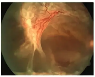 糖网Ⅵ期还能治吗？