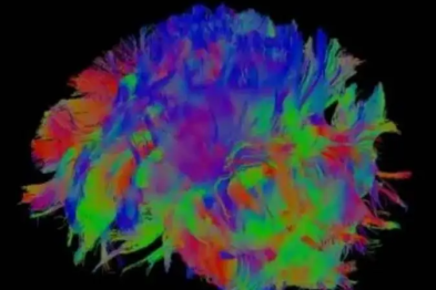 【高尚病例】MRI-DTI（3.0T 磁共振弥散张量成像）应用