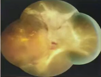 糖网Ⅵ期还能治吗？