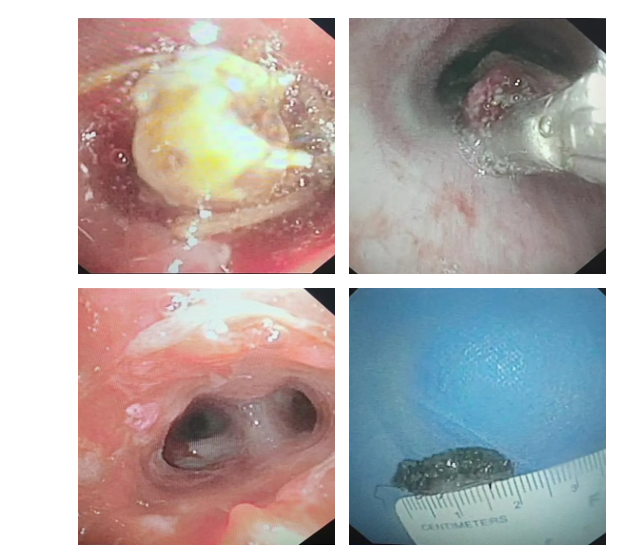 女子咳嗽咳痰、发热胸闷 5 天不见好，一「镜」破迷局！2 cm 异物藏气道