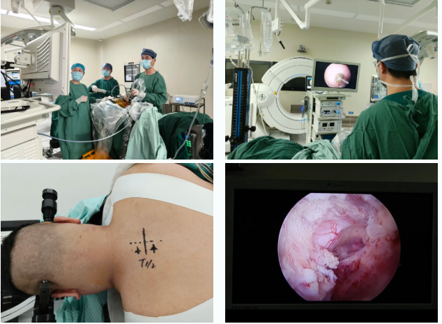 突破「手术禁区」—— 湖州市中心医院「三合一」精准微创治疗高位胸椎间盘突出